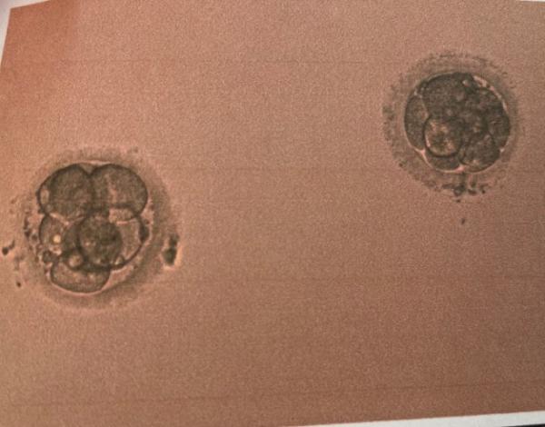Bild zu IVF mit zwei EZ was meint ihr? - Kinderwunschbehandlung