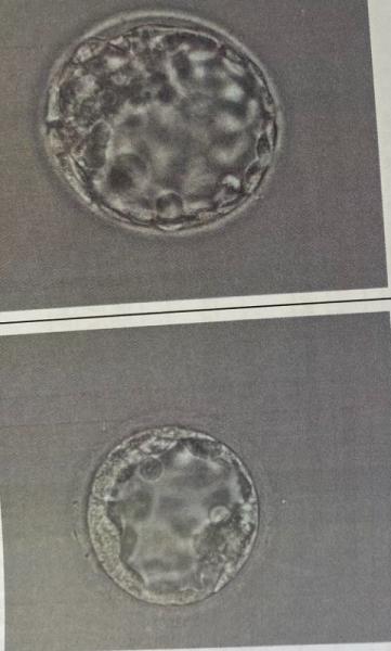 Bild zu IVF Austausch - Kinderwunschbehandlung