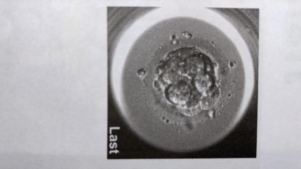 Bild zu Qualität des Embryos - Kinderwunschbehandlung