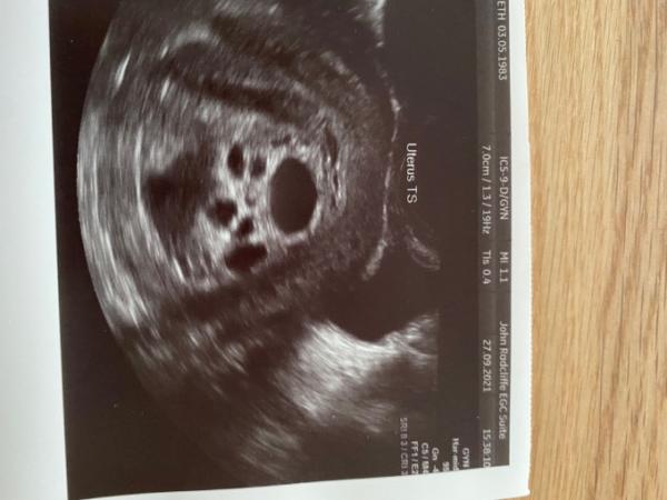 Bild zu 6+3 ulttaschall - Kinderwunschbehandlung