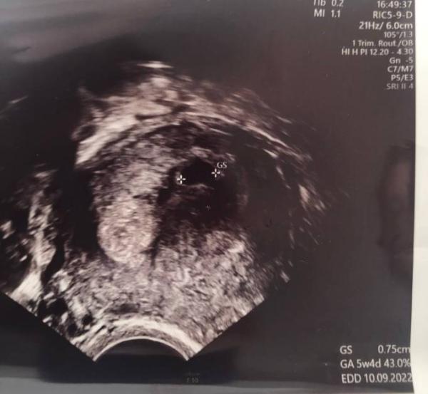Bild zu Insemination: schwanger, verdickte Eileiter, zwei Follikel - Kinderwunschbehandlung