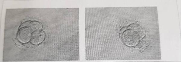 Bild zu 1 IFV ,transfert 4 und 6zeller habe ich damit eine chance ? - Kinderwunschbehandlung