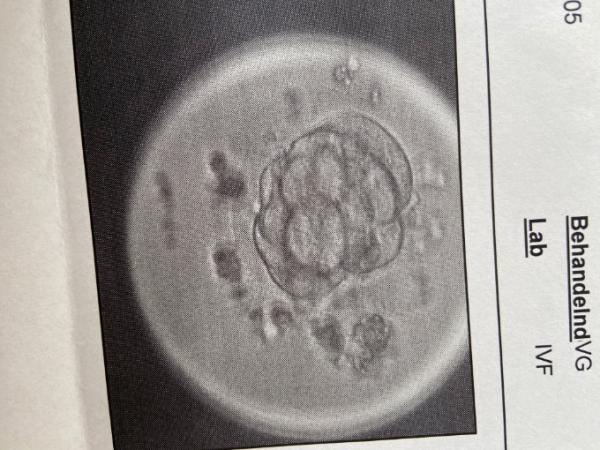 Bild zu An PU+5 nur eine Morula - Kinderwunschbehandlung