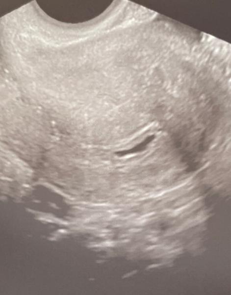 Bild zu Längliche Fruchthöhle - Kinderwunschbehandlung