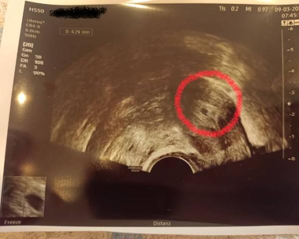 Bild zu Erstes Foto Baby - Kinderwunschbehandlung