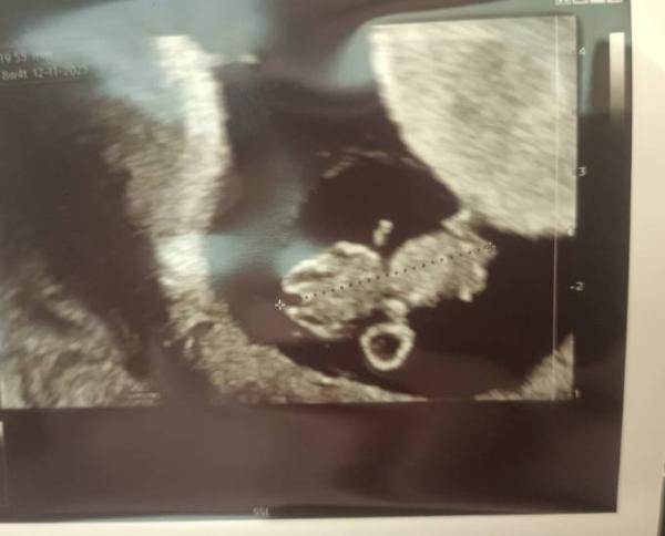 Bild zu Baby wächst und wächst 😍😍😍 - Kinderwunschbehandlung