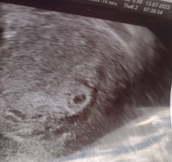 Bild zu Pu+24 (SSW 5+3) erstes Ultraschallbild bin soo aufgeregt - Kinderwunschbehandlung