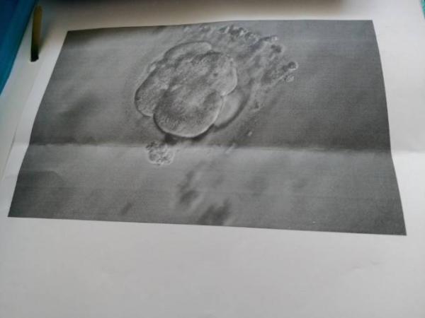 Bild zu Embryo Tag 3 - Kinderwunschbehandlung