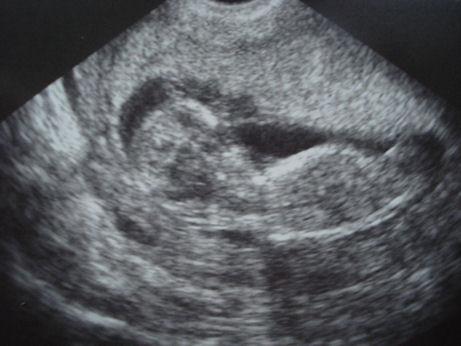 Bild zu Heute FA-Besuch und wieder krankgeschrieben... - Kinderwunsch - was tun, um schwanger zu werden?