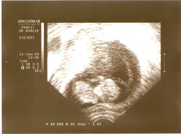 Bild zu mein US Foto von heute - Kinderwunsch - was tun, um schwanger zu werden?