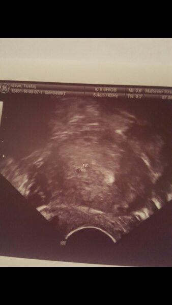 Bild zu Was seht ihr auf dem bild - Kinderwunsch - was tun, um schwanger zu werden?