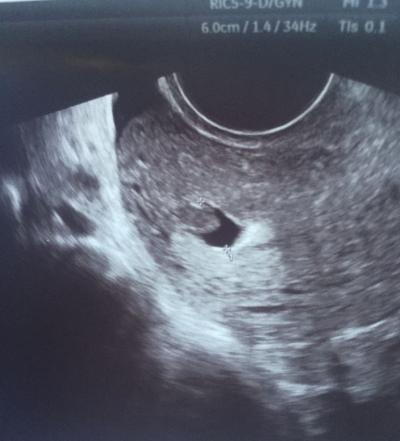 Bild zu Polyp in der Gebährmutter, Erfahrungen? - Kinderwunsch - was tun, um schwanger zu werden?