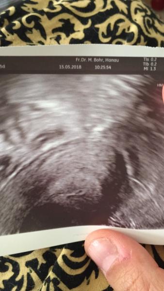 Bild zu Schwanger, aber Ultraschall zeigt nichts... - Kinderwunsch - was tun, um schwanger zu werden?