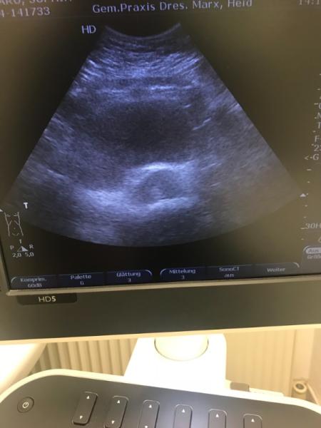 Bild zu Verdächtige Ultraschallbild? - Kinderwunsch - was tun, um schwanger zu werden?