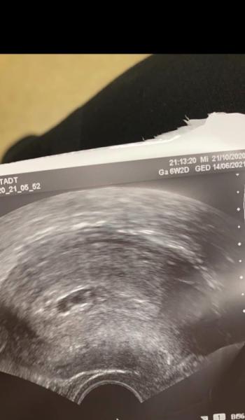 Bild zu Waren das Zwillinge? - Kinderwunsch - was tun, um schwanger zu werden?