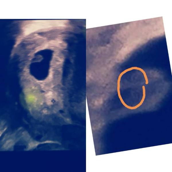 Bild zu Dottersack und fruchthöhle (keine inaktive SS) - Kinderwunsch - was tun, um schwanger zu werden?