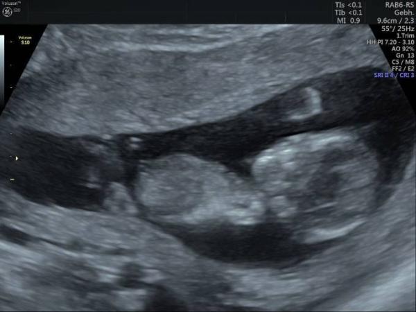 Bild zu 12+ 1 Geschlecht erkennbar? - Kinderwunsch - was tun, um schwanger zu werden?