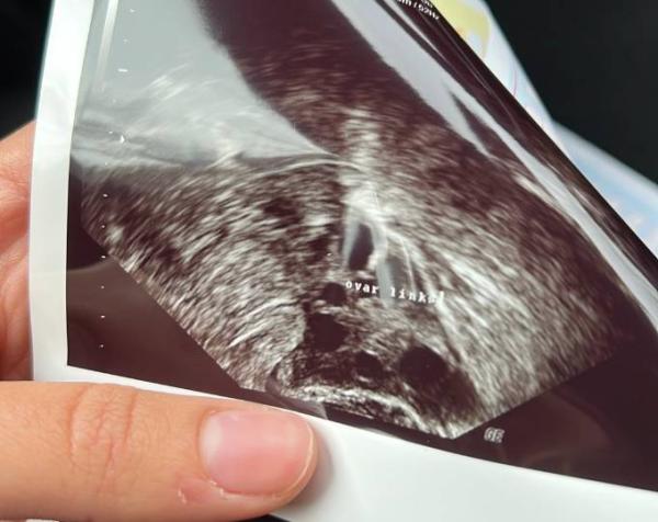 Bild zu Hilfe brauche rat PCO - Kinderwunsch - was tun, um schwanger zu werden?