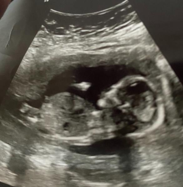 Bild zu Geschlecht Nub Theorie - Kinderwunsch - was tun, um schwanger zu werden?