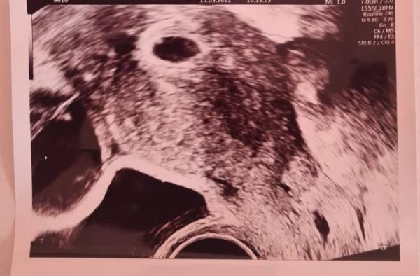 Bild zu Icsi 5+5 Ultraschall - Kinderwunsch - was tun, um schwanger zu werden?