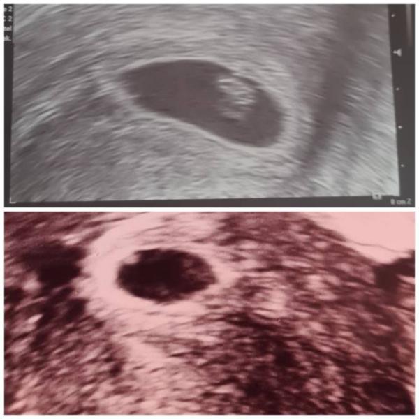 Bild zu Icsi 5+5 ssw und 6+4 ssw Ultraschall - Kinderwunsch - was tun, um schwanger zu werden?