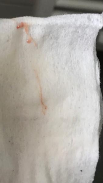Bild zu Minimal Blut im zervixschleim - Kinderwunsch - was tun, um schwanger zu werden?