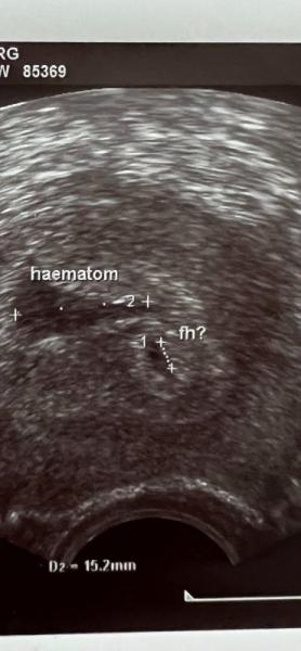 Bild zu Hämatom in der Gebärmutter - Kinderwunsch - was tun, um schwanger zu werden?