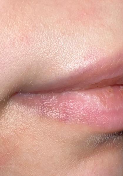 Bild zu Herpes kurz vor Entbindung - Kinderwunsch - was tun, um schwanger zu werden?