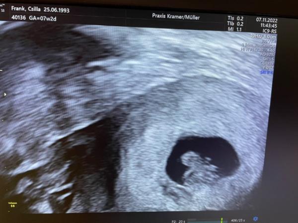 Bild zu Ultraschall - Kinderwunsch - was tun, um schwanger zu werden?