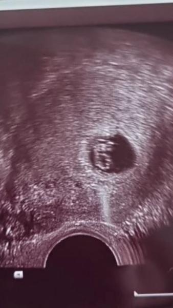 Bild zu Sorgerecht für Vater - Kinderwunsch - was tun, um schwanger zu werden?
