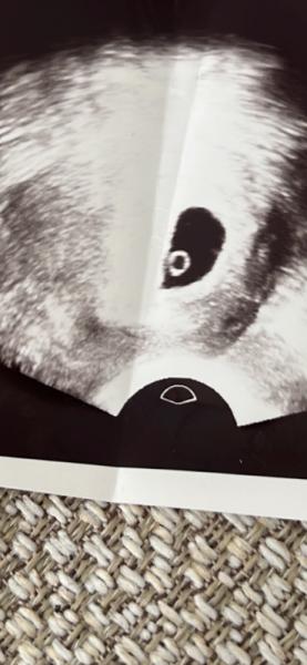 Bild zu Dotersack ohne Embrio - Kinderwunsch - was tun, um schwanger zu werden?