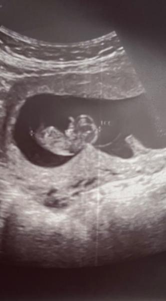 Bild zu Komische Form der Fruchthöhle? - Kinderwunsch - was tun, um schwanger zu werden?