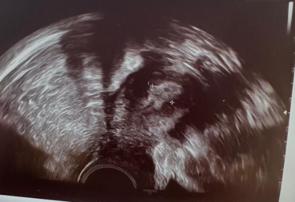 Bild zu Schleimhaut aufgebaut ss? - Kinderwunsch - was tun, um schwanger zu werden?