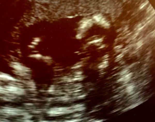 Bild zu Geschlecht ersichtlich? 💙💜 - Kinderwunsch - was tun, um schwanger zu werden?