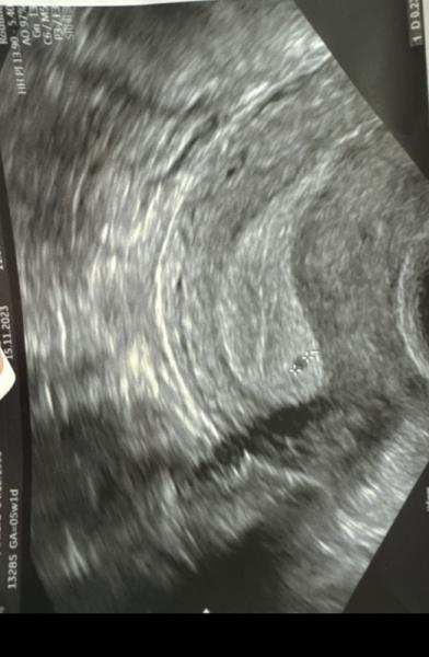 Bild zu Kleiner schwarzer Punkt im Gebärmutter - Kinderwunsch - was tun, um schwanger zu werden?