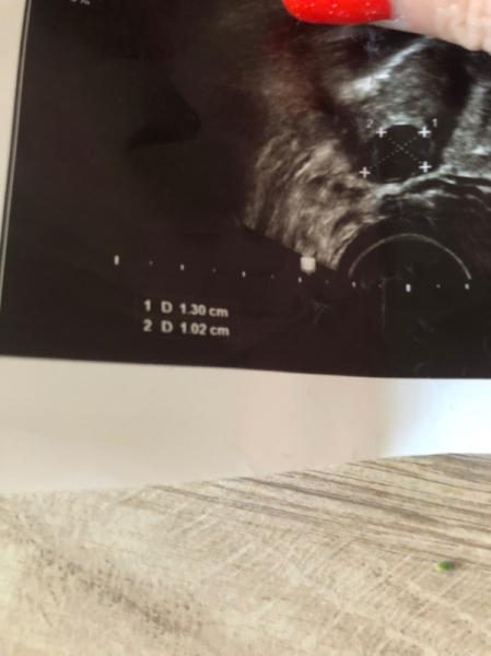 Bild zu Unreifer Follikel springt - Kinderwunsch - was tun, um schwanger zu werden?
