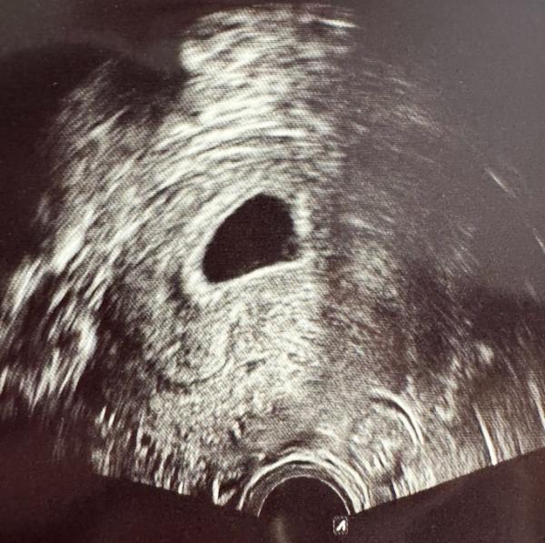 Bild zu 5+6 Ultraschall - Kinderwunsch - was tun, um schwanger zu werden?