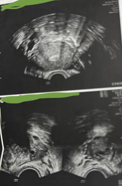 Bild zu Vag. Ultraschall/ Ultraschallbild erkennen - Kinderwunsch - was tun, um schwanger zu werden?
