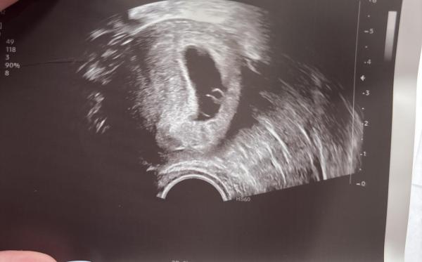 Bild zu Hilfe zum Ultraschallbild - Kinderwunsch - was tun, um schwanger zu werden?