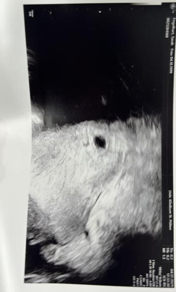 Bild zu SSW 5 + 5 - hoher HCG Wert - nur Fruchthöhle zu sehen - Kinderwunsch - was tun, um schwanger zu werden?