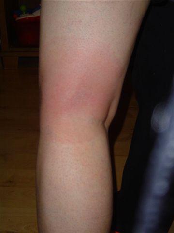 Bild zu Borreliose???? Schaut mal mein Bein an??!! - Aktuelles