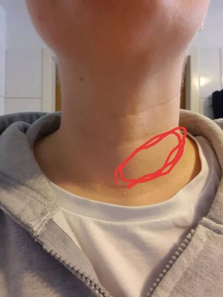 Bild zu Geschwollener Hals - Aktuelles