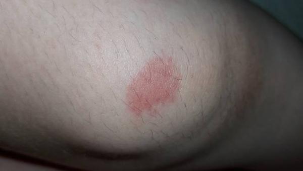 Bild zu Roter Fleck auf knie - Aktuelles
