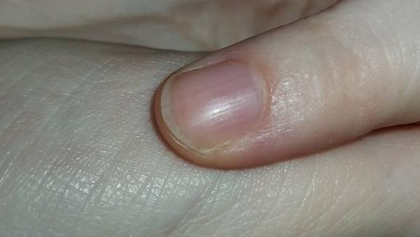 Bild zu Komischer Fingernagel - Aktuelles
