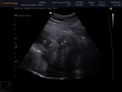 Bild zu 3D Ultraschall und wahrscheinlich Outing - Forum für Januar - Mamis