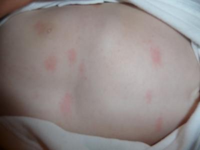 Bild zu am ganzen körper rote flecke nach molkebad - Forum für Januar - Mamis
