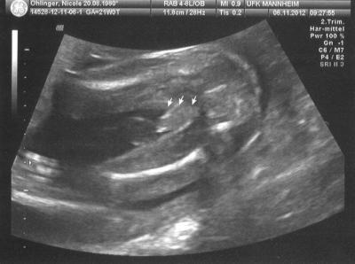 Bild zu Heute Feindiagnostik + Outing + Bilder + Bauchbild - Forum für Januar - Mamis