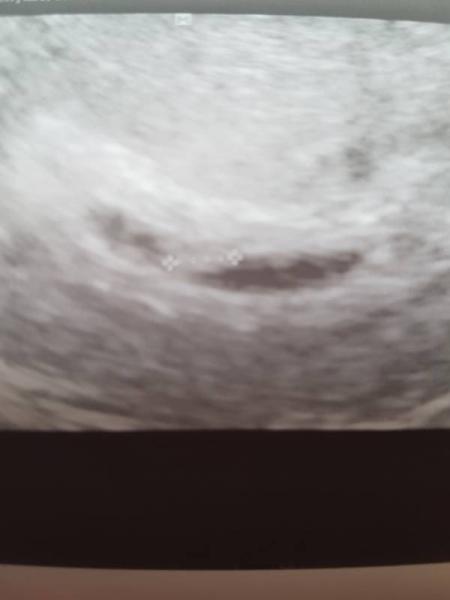 Bild zu Sehr lange Fruchthöhle. - Forum für Januar - Mamis
