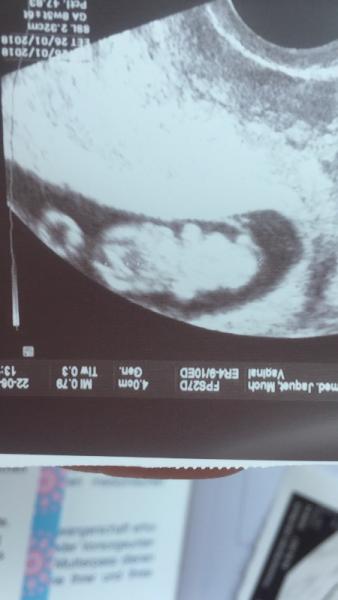 Bild zu Gebärmutteranomalie - Forum für Januar - Mamis