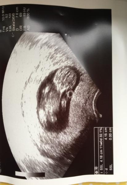 Bild zu Erster großer Ultraschall - Forum für Januar - Mamis